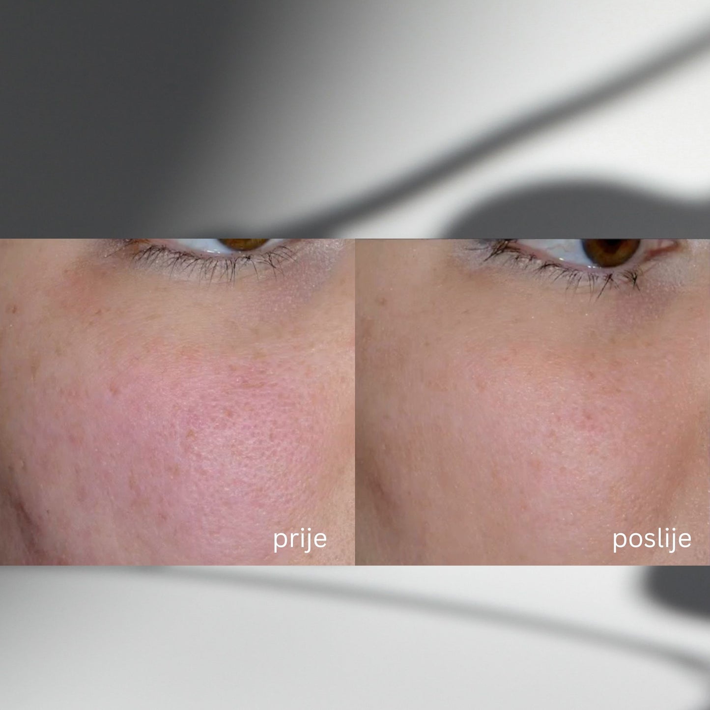 AQUAGOLD® fine touch™