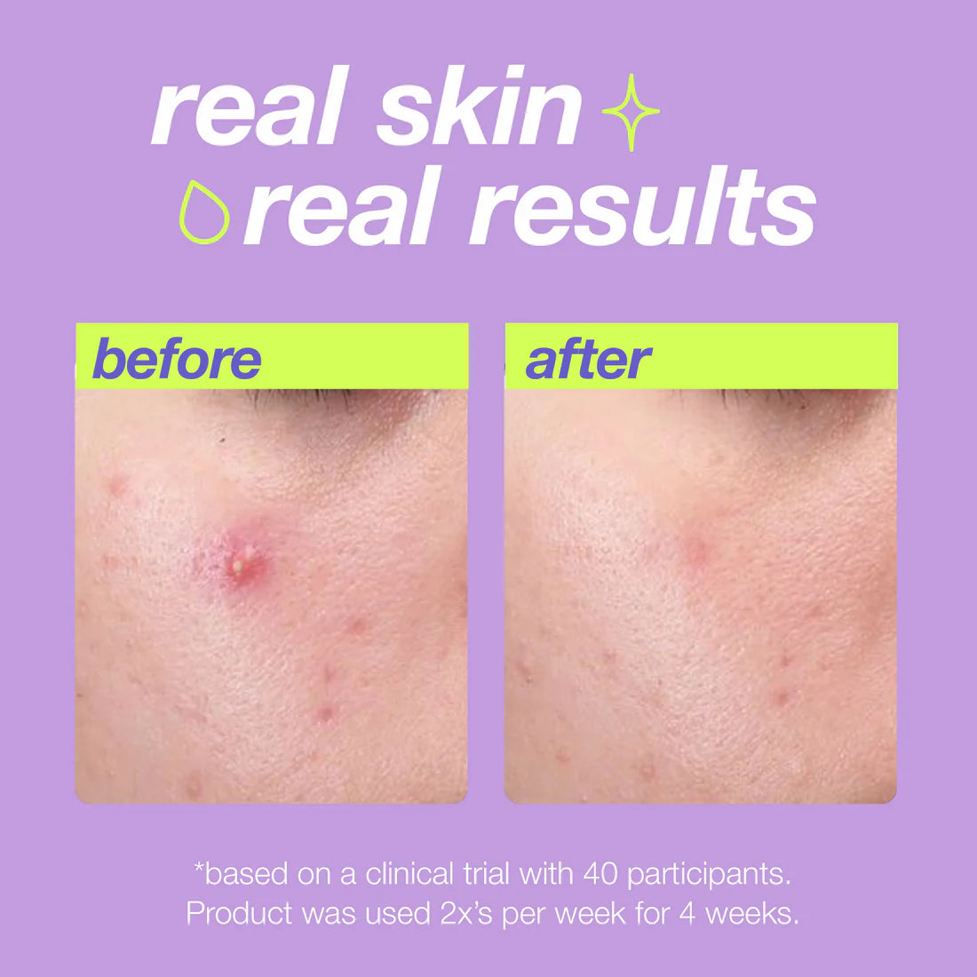 Breakout Liquid Peel